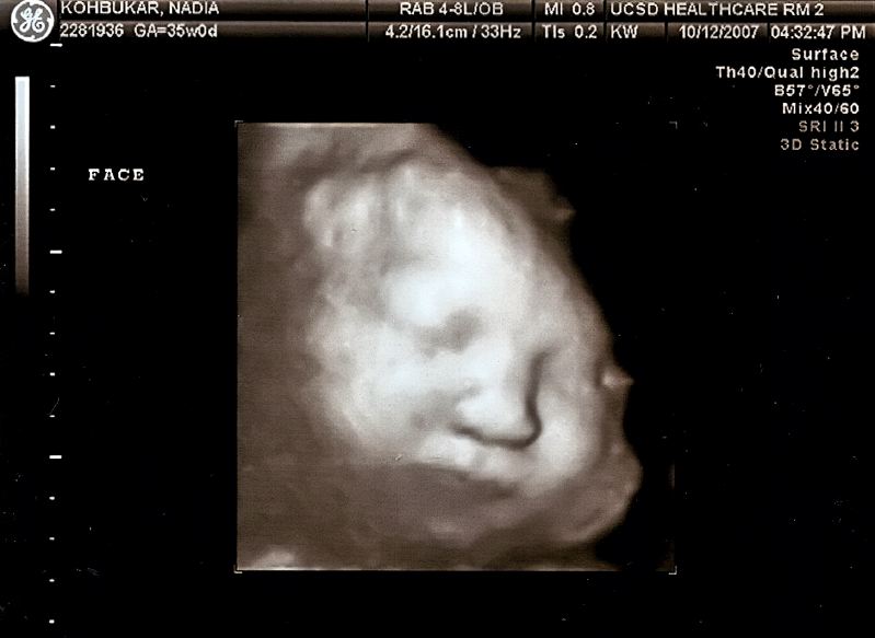 Thea 3D Front View- 35 Weeks