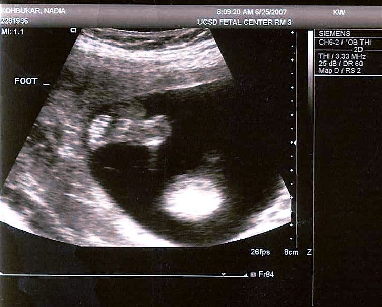 Thea's Foot - 20 Weeks