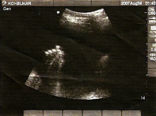 Thea's hand - 27 Weeks
