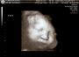 Thea 3D Front View- 35 Weeks