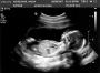 Thea - 17 Weeks