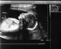 Thea Profile - 20 Weeks