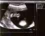 Thea's Foot - 20 Weeks