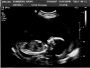 Thea Profile - 22 Weeks